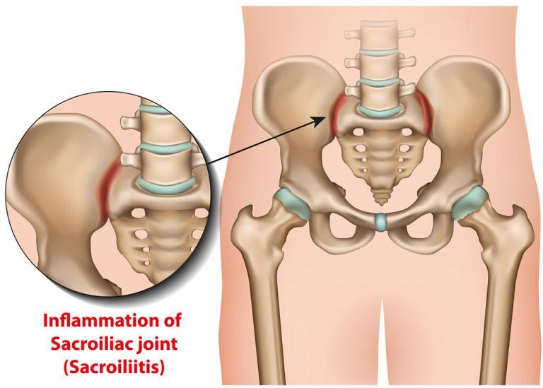 sacroiliac joint pain treatment ct