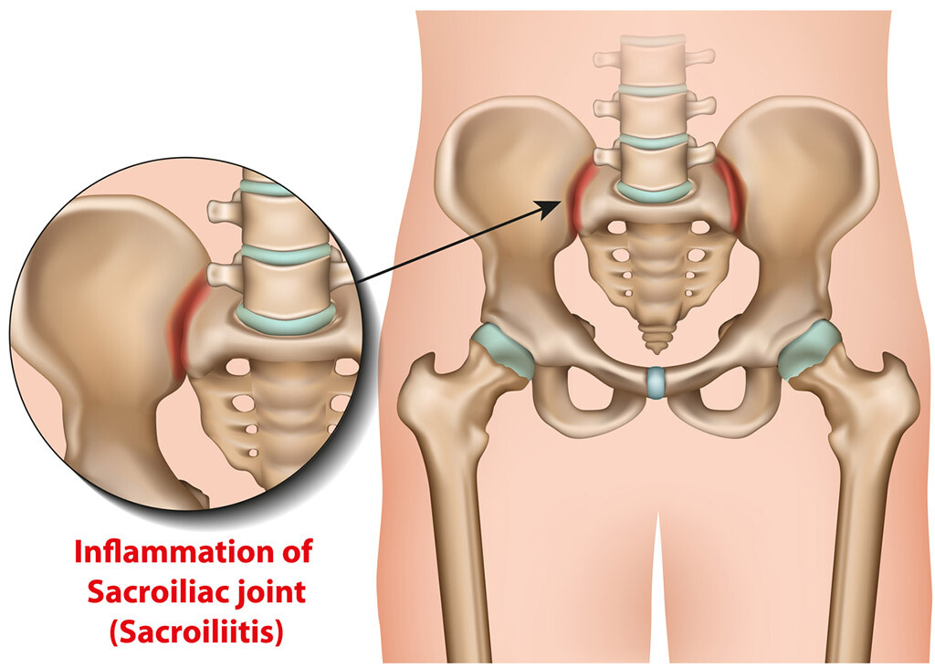 sacroiliac joint pain treatment ct