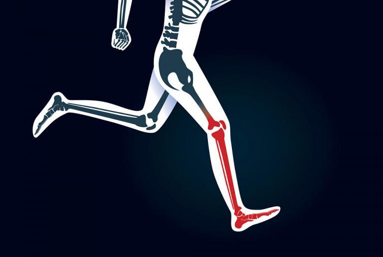 shin splint treatment ct