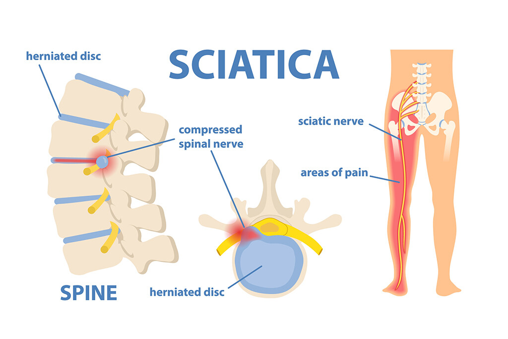how chiropractic care helps with sciatica